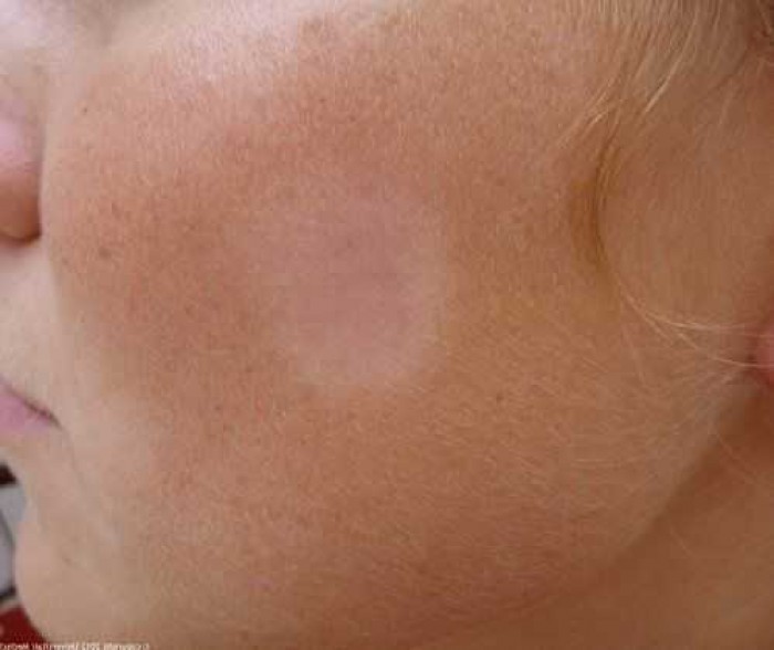 Pityriasis Alba: Pengertian, Gejala, Penyebab, dan Pengobatannya