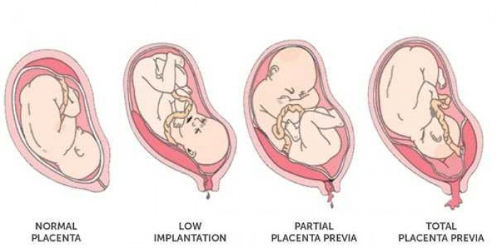 Plasenta Previa: Gejala, Penyebab, dan Pengobatan