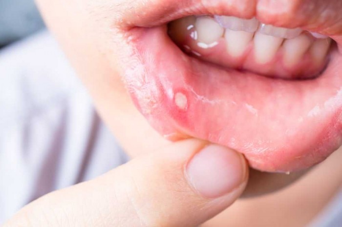 8 Penyebab Gusi Bengkak dan Cara Mengobatinya