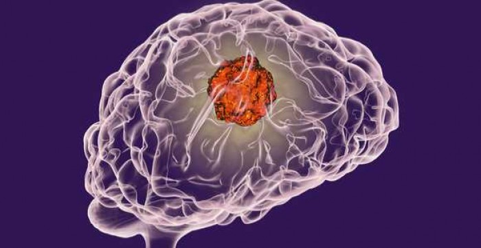 Tumor Otak: Gejala, Penyebab, dan Pengobatannya