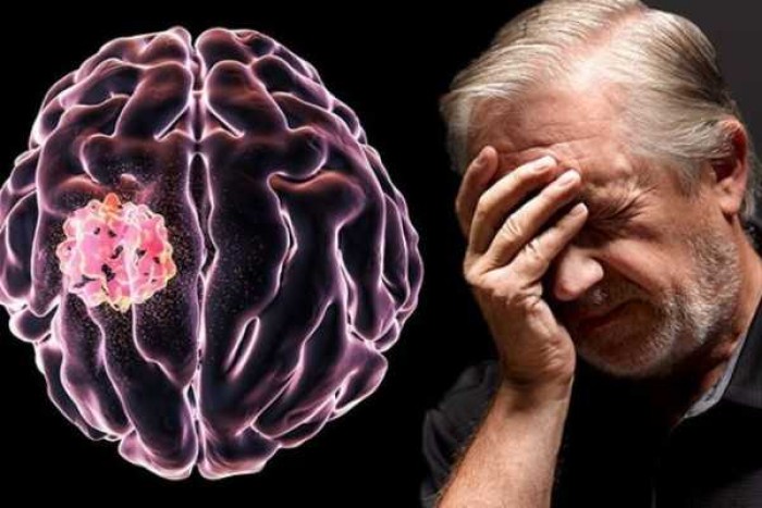 Tumor Otak: Gejala, Penyebab, dan Pengobatannya