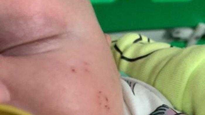 Bayi ini Menangis Malam Hari Dianggap Biasa Ternyata Digigit Hewan Beracun ini Bayi ini Menangis Malam Hari Dianggap Biasa Ternyata Digigit Hewan Beracun ini