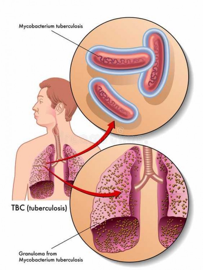 Penyakit TBC: Penyebab, Gejala, Pengobatan, dan Pencegahan