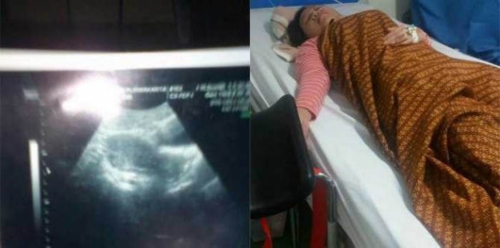 Gara-Gara KB, Rahim Wanita ini Infeksi Sampai Bengkak