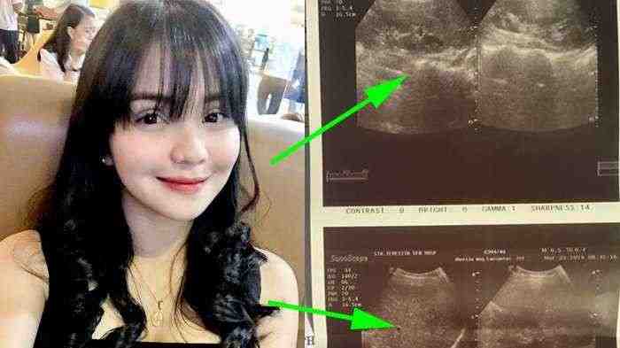 Jangan Sepelekan Pentingnya Sarapan, Lihat Nasib Wanita ini Kondisinya Mengenaskan