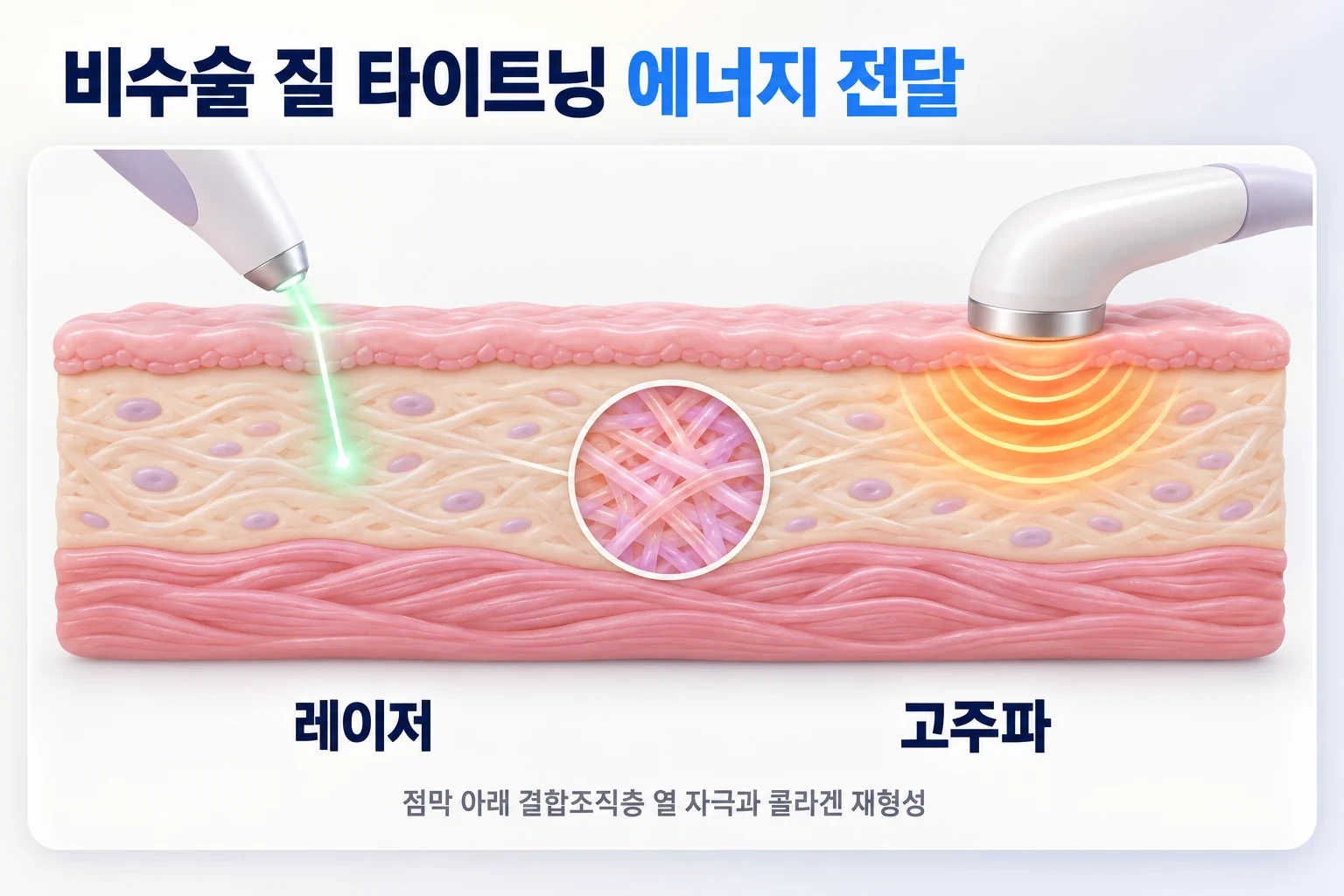 레이저 빛과 고주파 열이 질 점막을 지나 결합조직층에 전달되는 과정을 층별로 나타낸 모식도