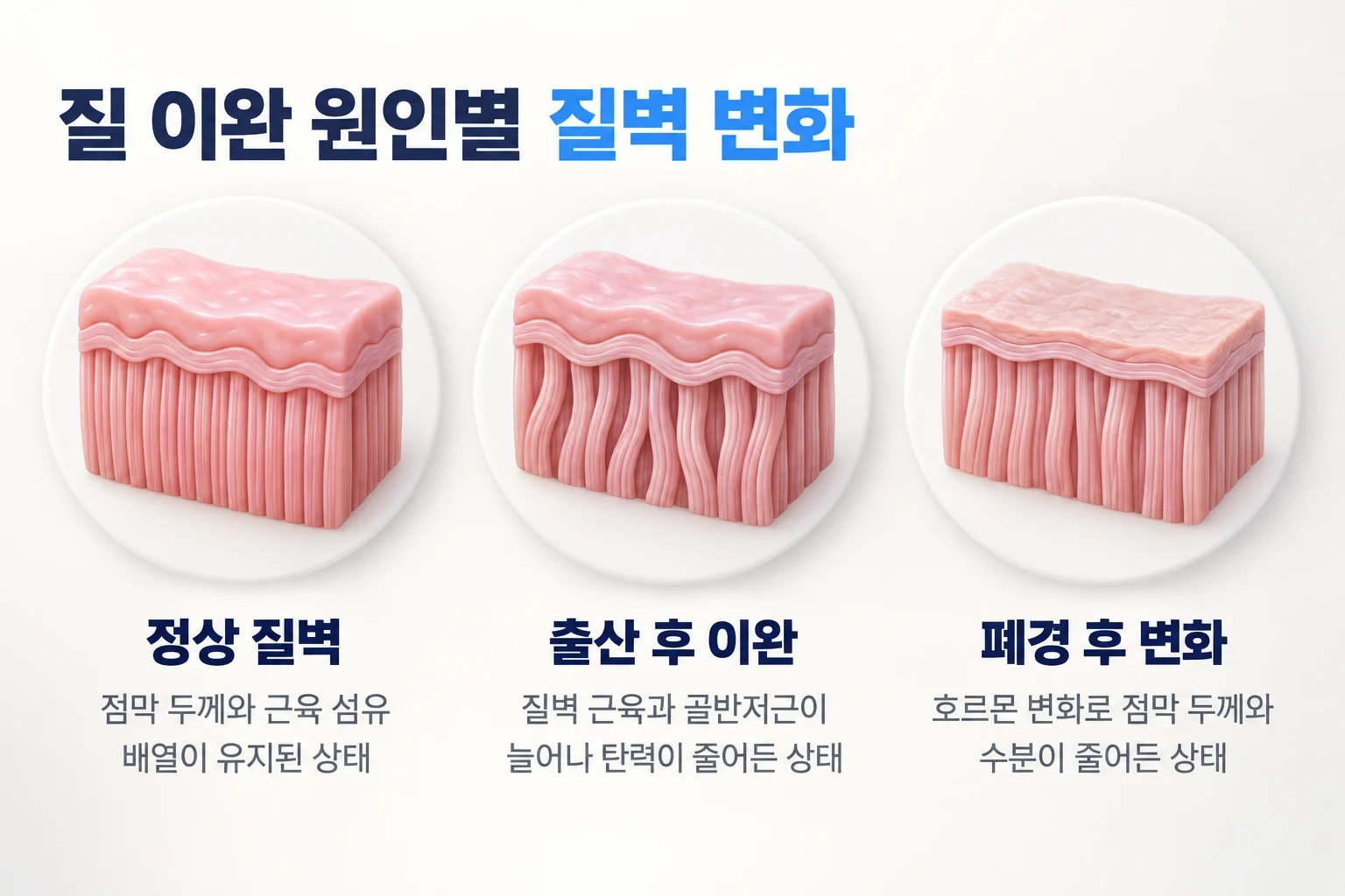 정상 질벽, 출산 후 늘어난 근육과 골반저근, 폐경 후 얇아진 점막을 비교한 확대 일러스트