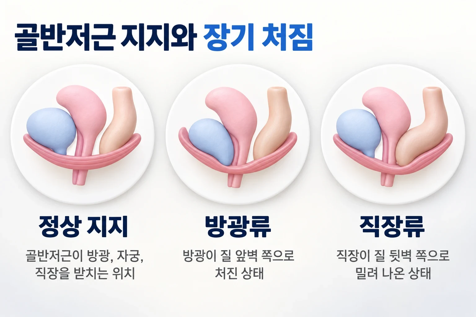 여성수술 전 확인해야 할 골반저근의 정상 지지 상태와 방광류, 직장류 모습을 비교한 골반 단면 모식도