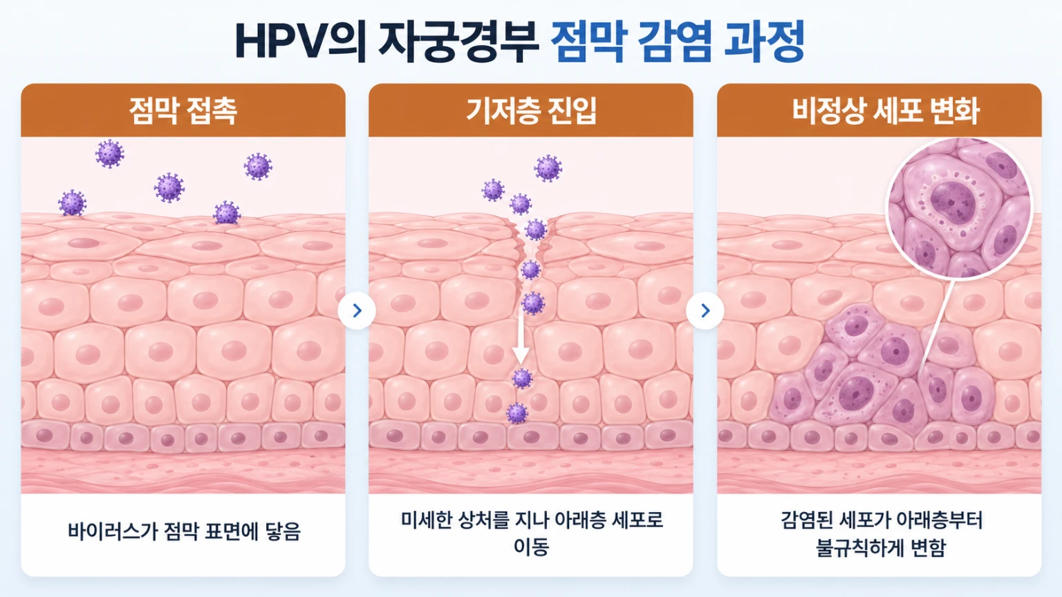 점막 표면 부착, 기저층 진입, 세포 변화 순서로 HPV 감염 단계를 확대해 그린 설명용 개념도