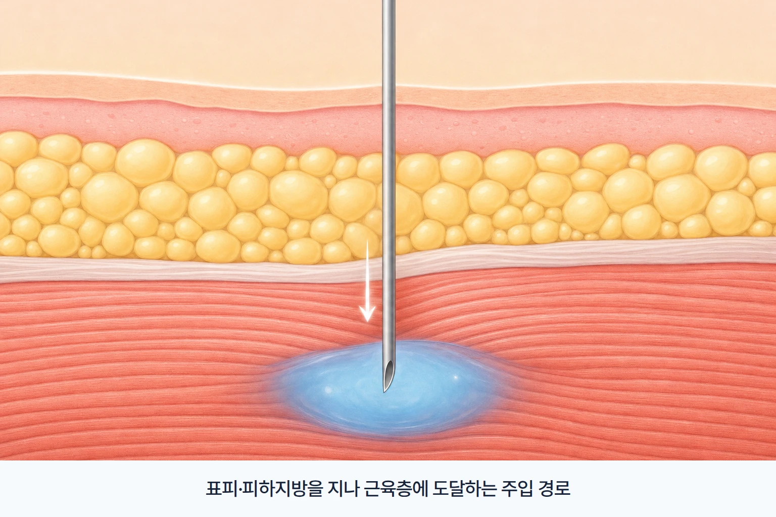 표피와 피하지방을 지나 근육층에 도달하는 가다실 주사 주입 깊이를 층별로 표현한 단면도