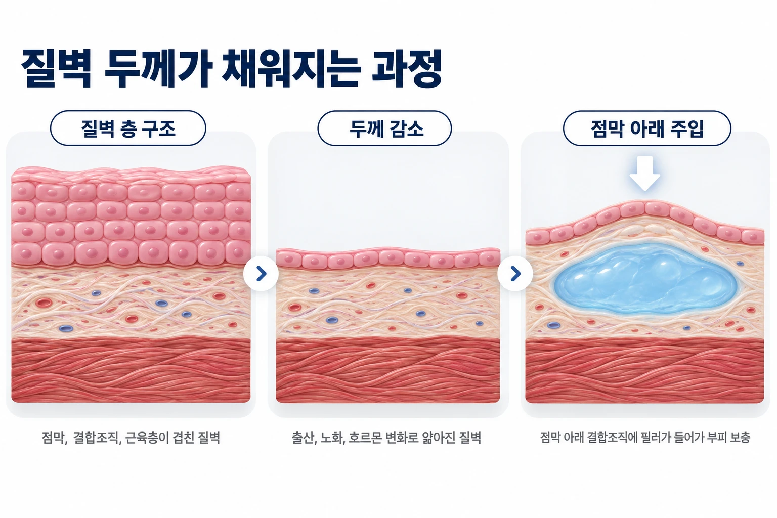 질필러를 점막 아래 결합조직에 주입해 얇아진 질벽의 두께를 채우는 과정을 3단계로 나타낸 개념도
