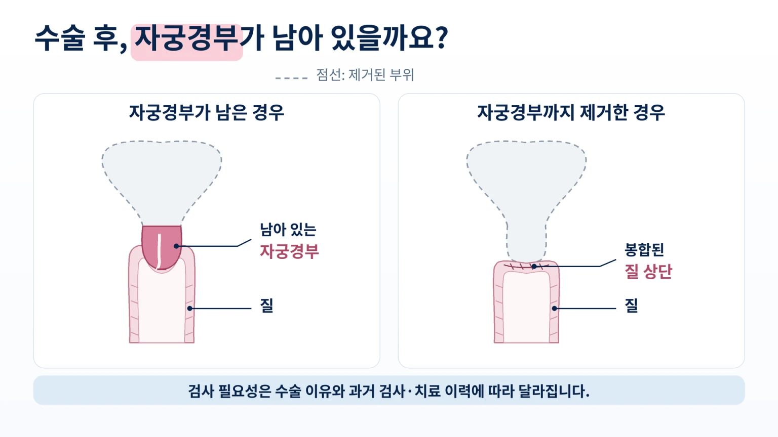 자궁 절제 범위에 따라 자궁경부가 남는 경우와 남지 않는 경우 비교 모식도