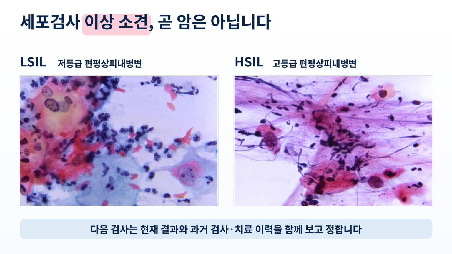 자궁경부 세포검사의 저등급 병변 LSIL과 고등급 병변 HSIL을 비교한 실제 현미경 사진