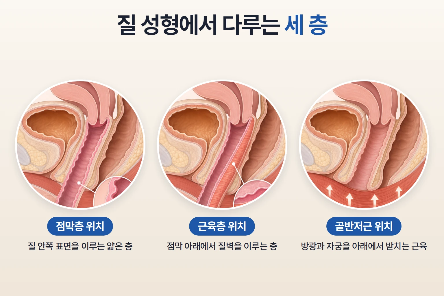 골반 시상면에서 점막층, 근육층, 골반저근의 위치 관계를 층별로 표시한 단면 모식도