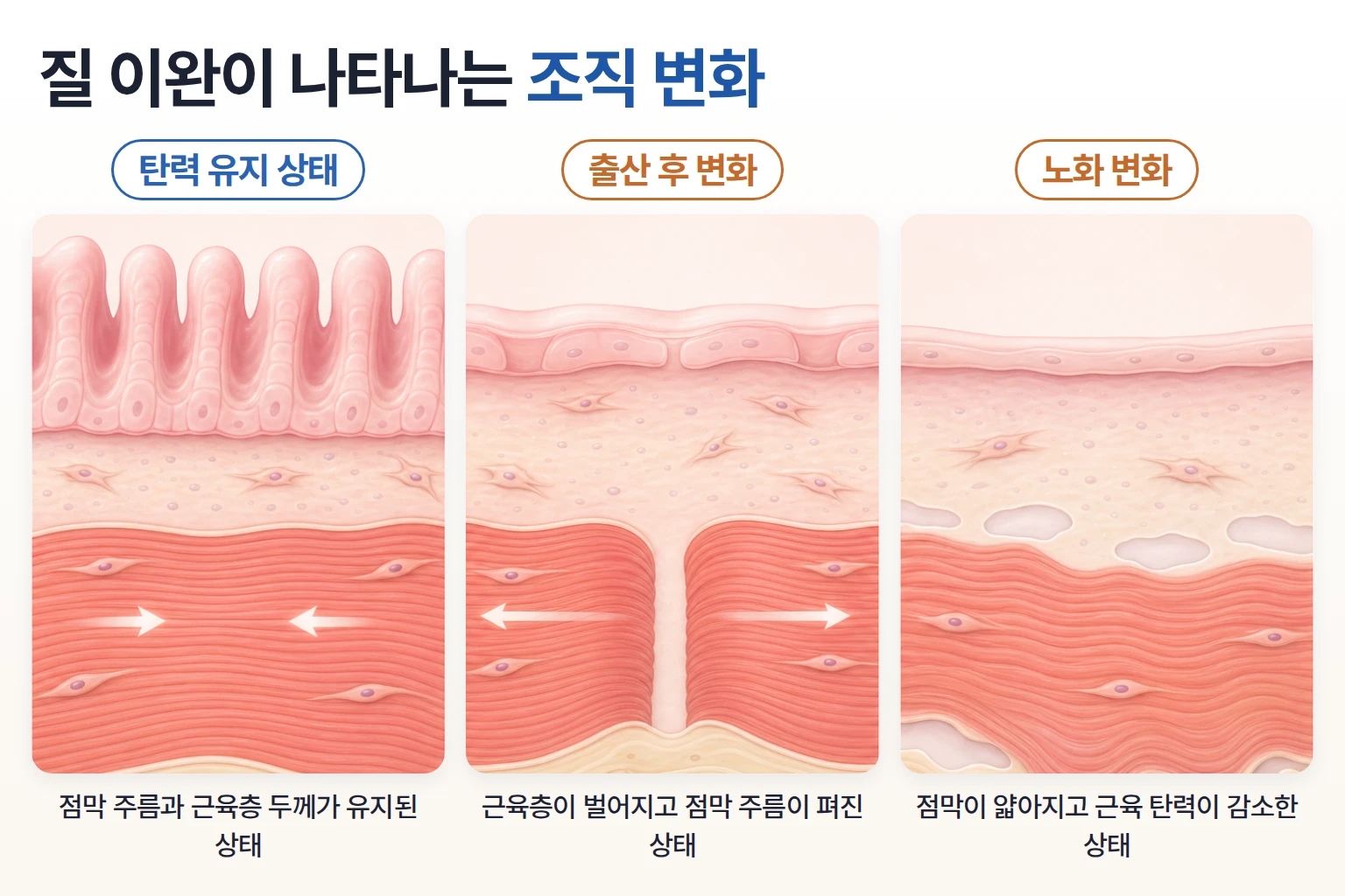 점막 주름과 근육층 두께를 기준으로 탄력 유지, 출산 후, 노화 변화를 비교한 조직 모식도