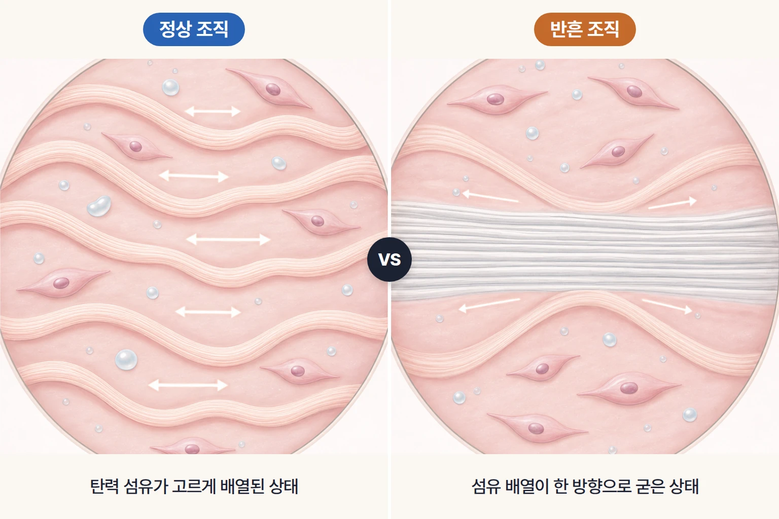 정상 조직과 이전 수술로 생긴 반흔 조직의 섬유 배열 차이를 확대해 비교한 모식도