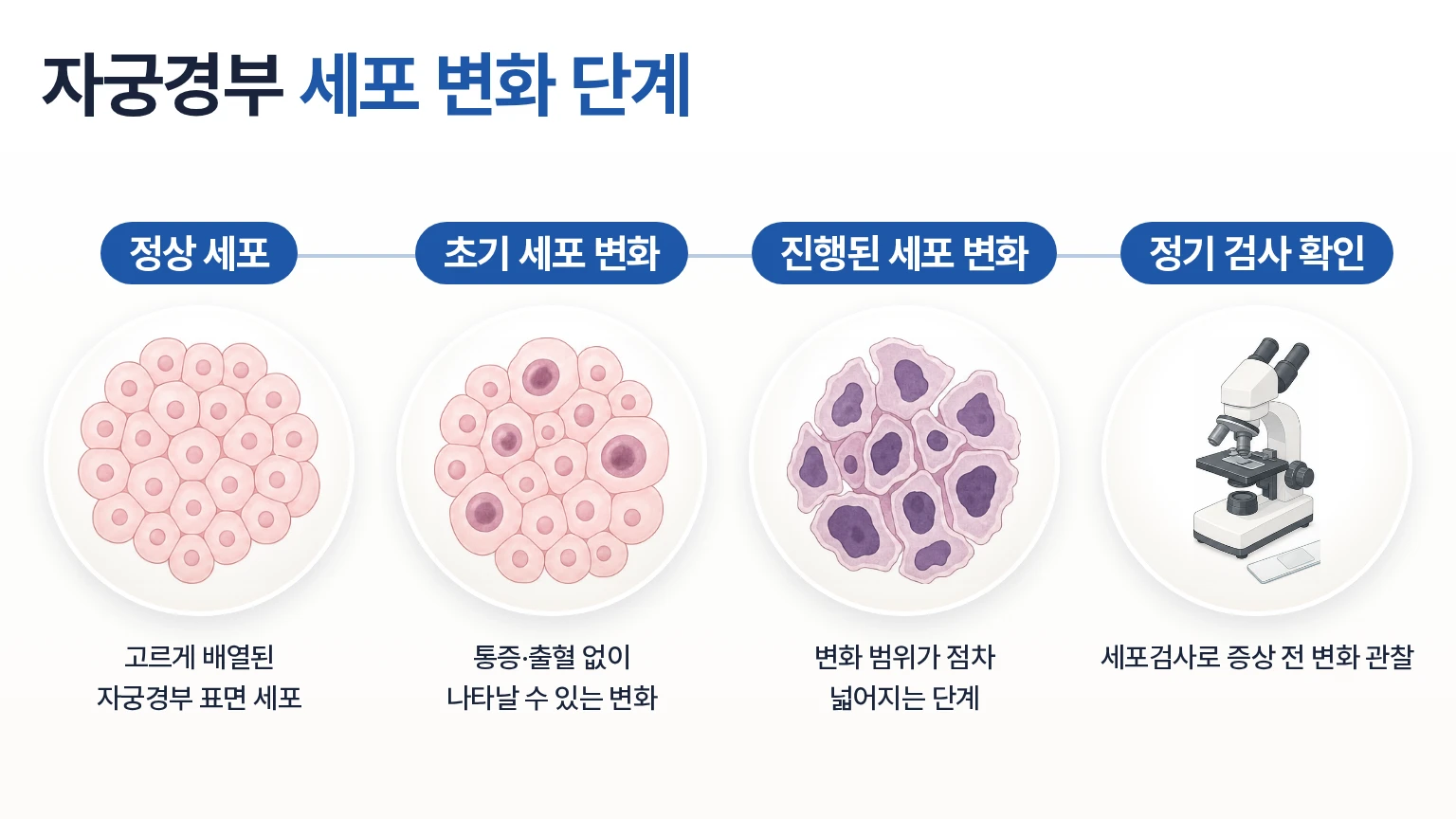 정상 세포에서 초기 변화, 진행된 변화로 이어지는 자궁경부 세포 단계를 정리한 타임라인 이미지