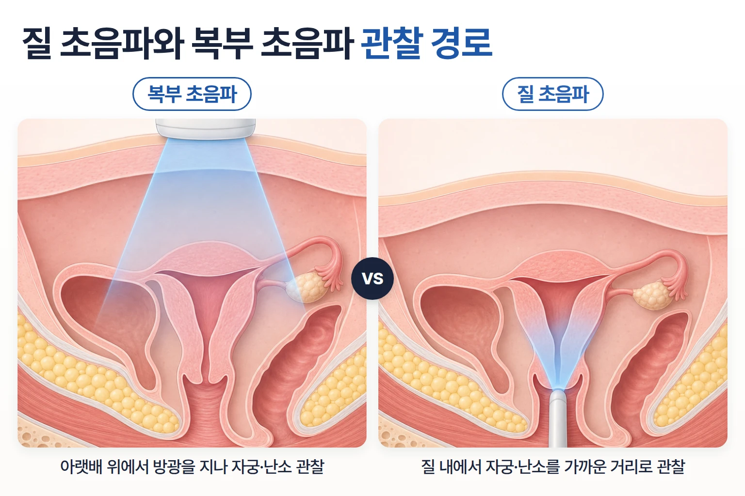 아랫배 위와 질 내에서 자궁과 난소로 향하는 초음파 경로를 나란히 비교한 골반 단면 도식