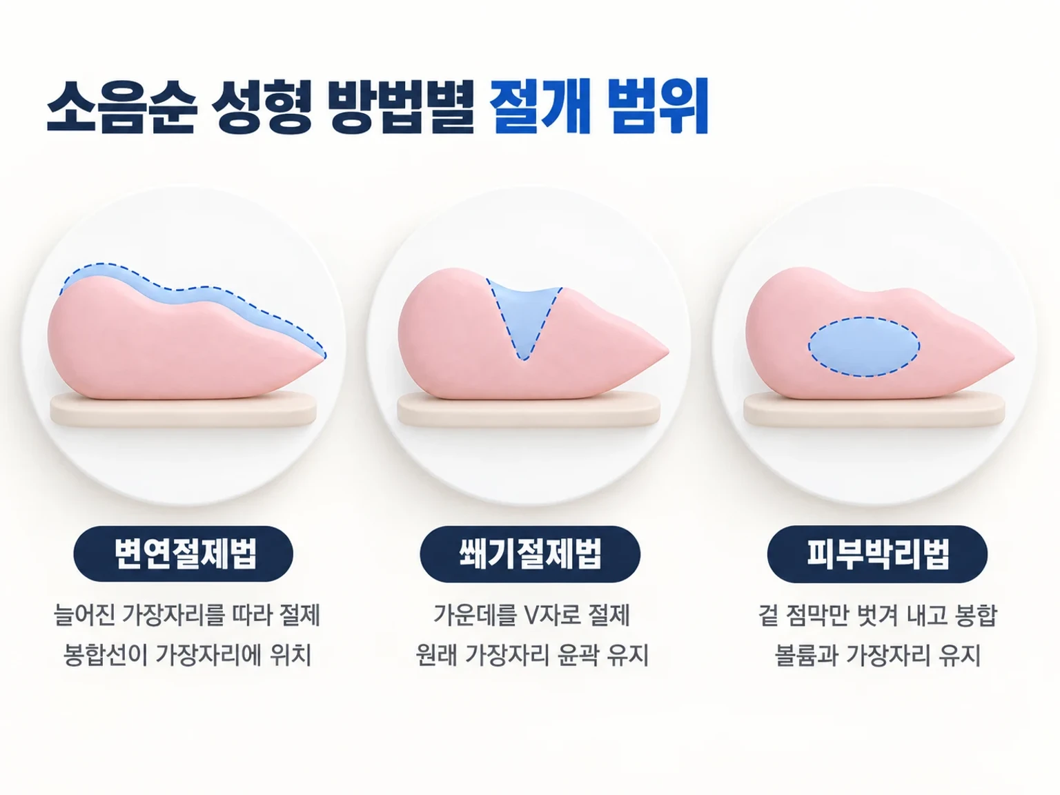 변연절제, 쐐기절제, 피부박리의 절개 범위를 단순한 도형 위에 색으로 구분한 비교 개념도