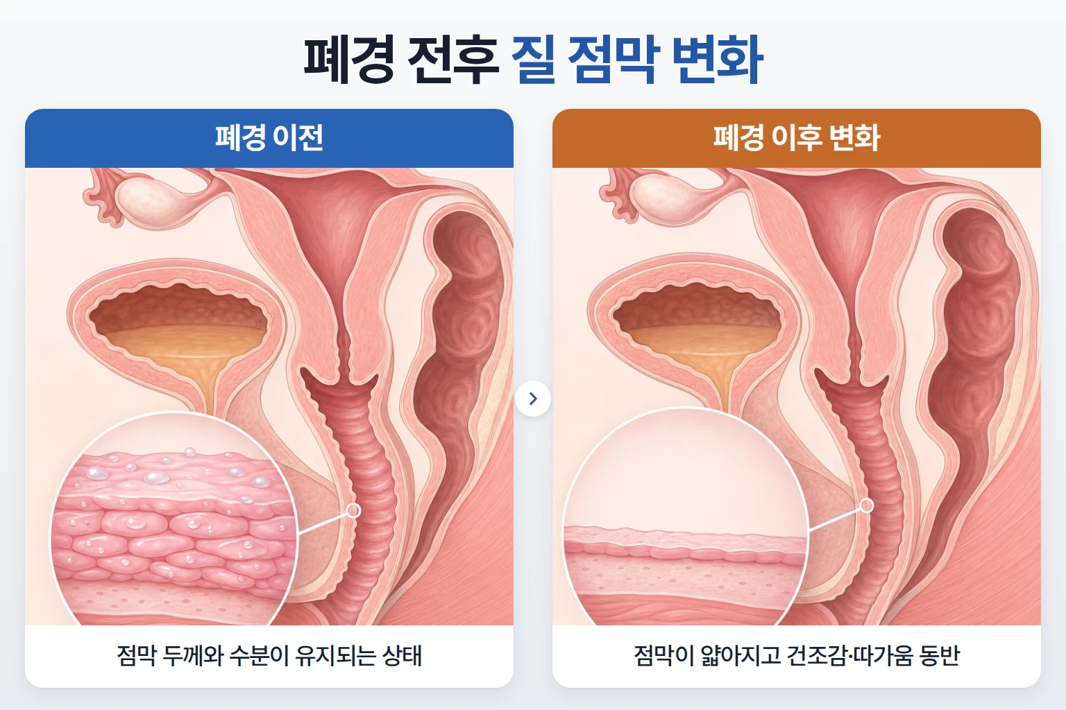 폐경 이전과 이후 질 점막 두께와 수분 차이를 확대 인셋으로 비교한 골반 단면 모식도