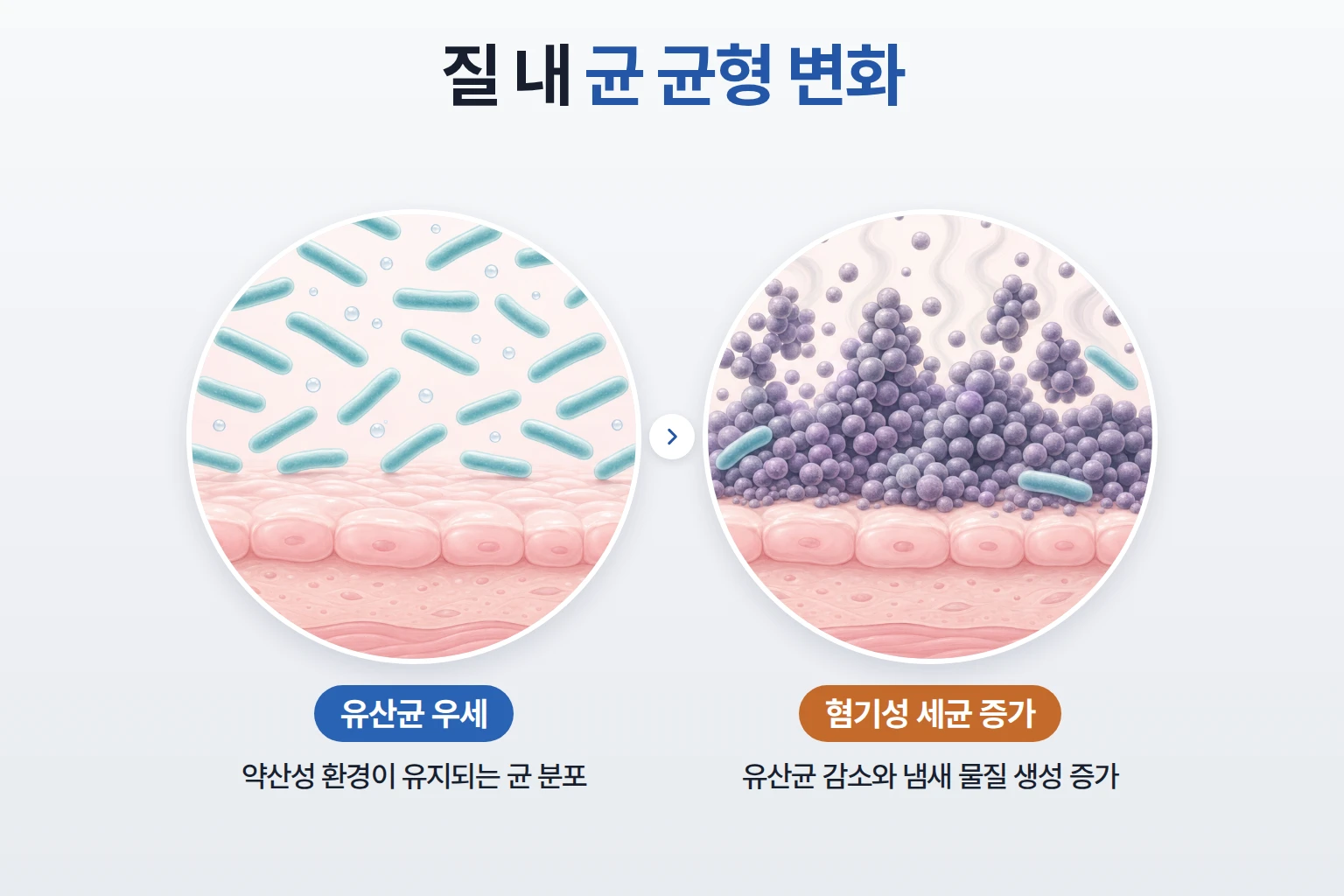 질 내 유산균 우세 상태와 혐기성 세균이 늘어난 분포를 동일 배율로 비교한 확대 모식도
