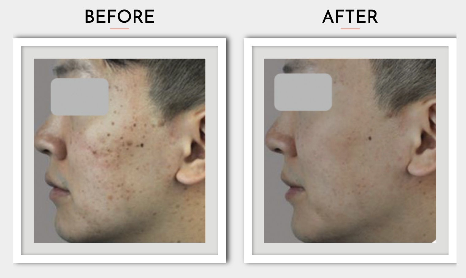 Is Fractional Laser the Best Way to Remove Acne Scars