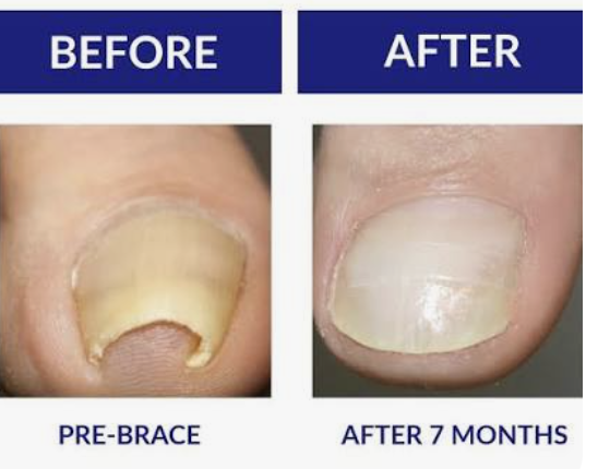Is Ingrown Toenail Relief Without Surgery Really Possible?