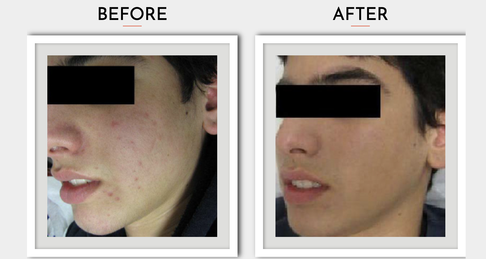 Teen Acne: What to Know and What to Do
