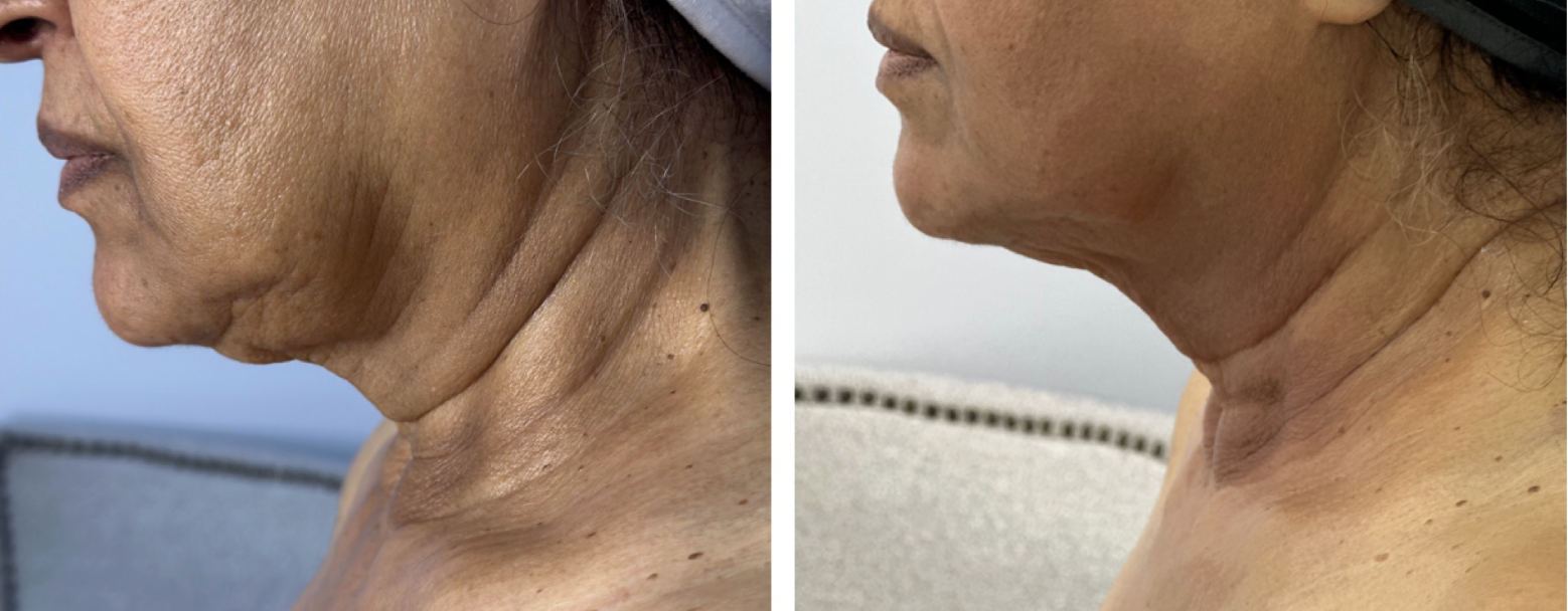 Facelift Without Surgery: Is It Possible?