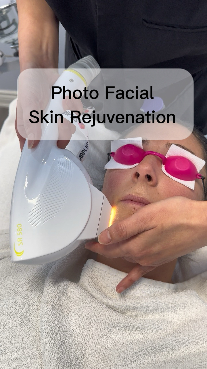 IPL Photofacial: Things to Know