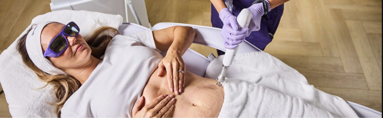 How To Choose Between Fractional Laser And Microneedling