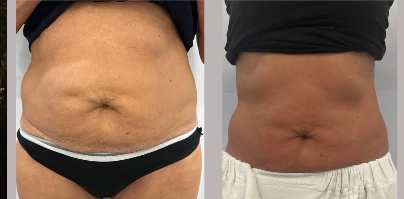 Body Contouring: What You Need to Know