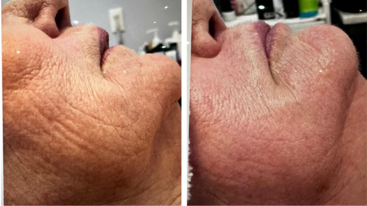 How Often Should I Get a Facial? A Professional Guide to Healthy Skin