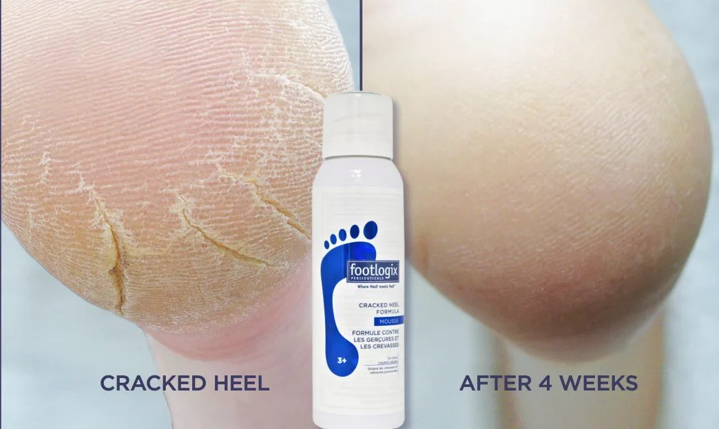 How to Fix Dry, Cracked Heels: Why Scraping Alone Isn't the Answer