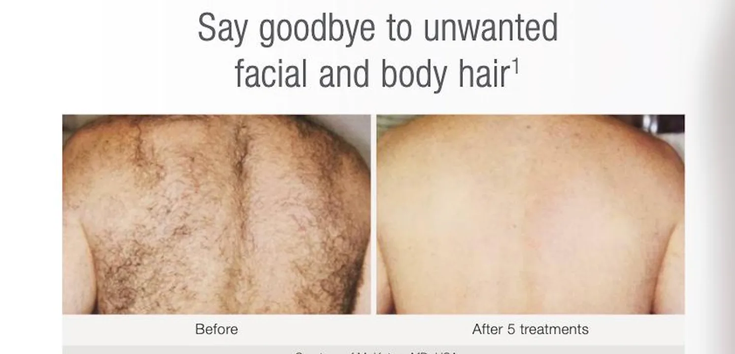 Why September Is the Perfect Time to Start Laser Hair Removal