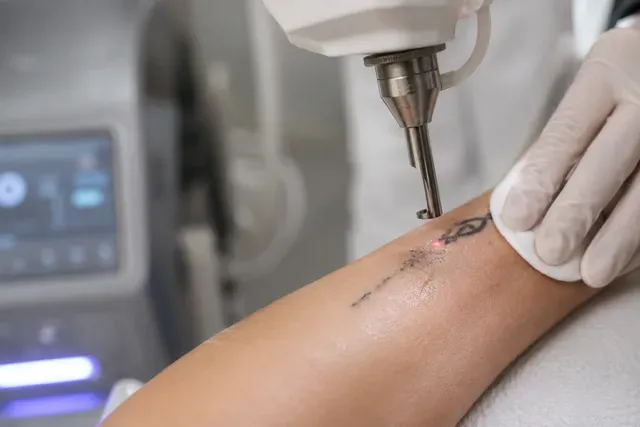 Tattoo Removal with Laser image background image