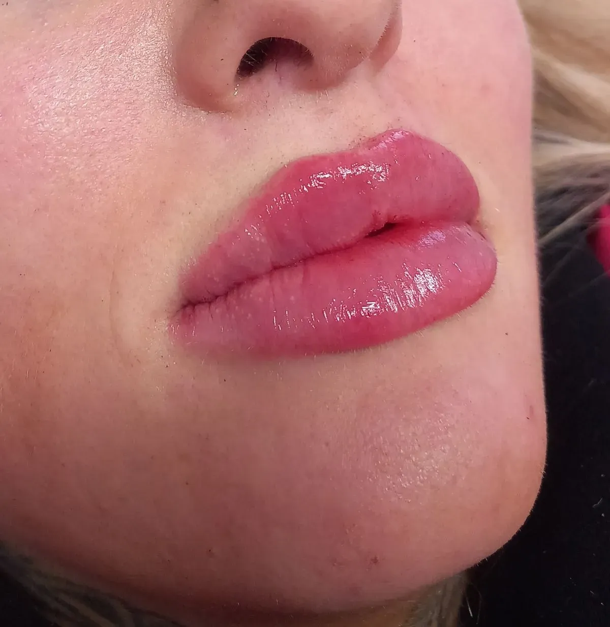 Dermal fillers image background image