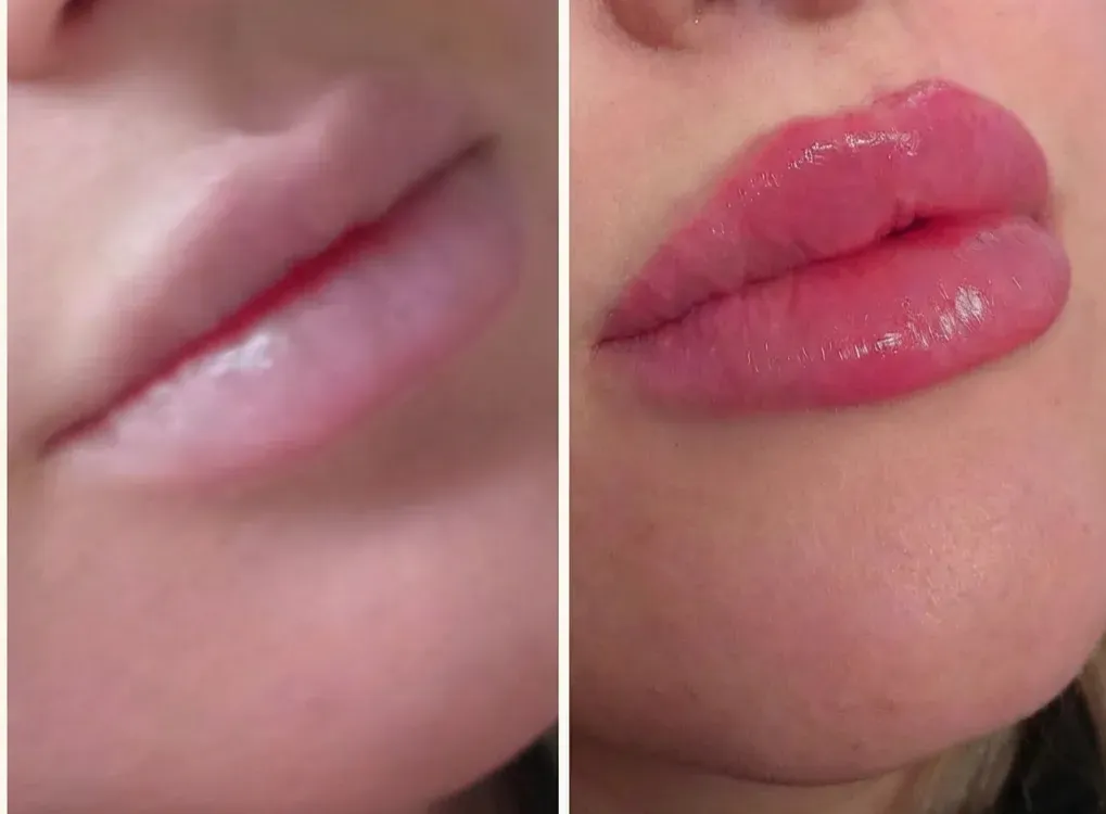 Dermal fillers image