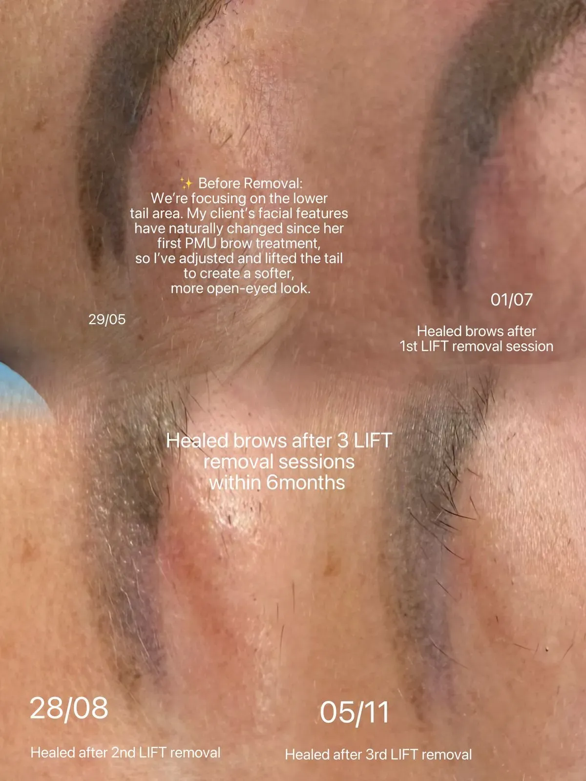 Tattoo Removal image background image