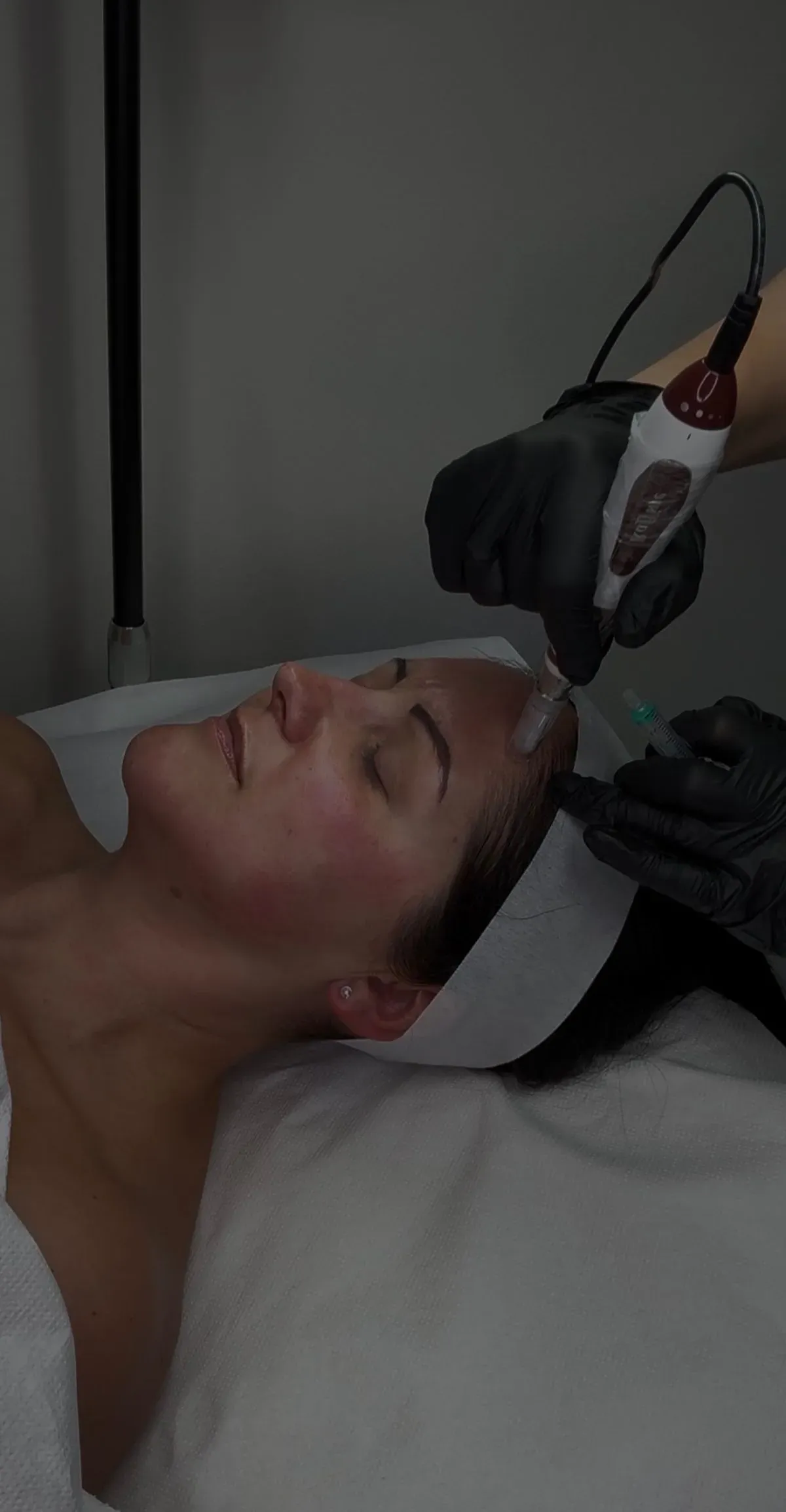 Microneedling image