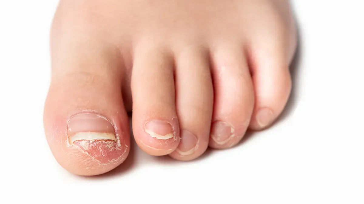 Nail trimming in Rawcliffe
