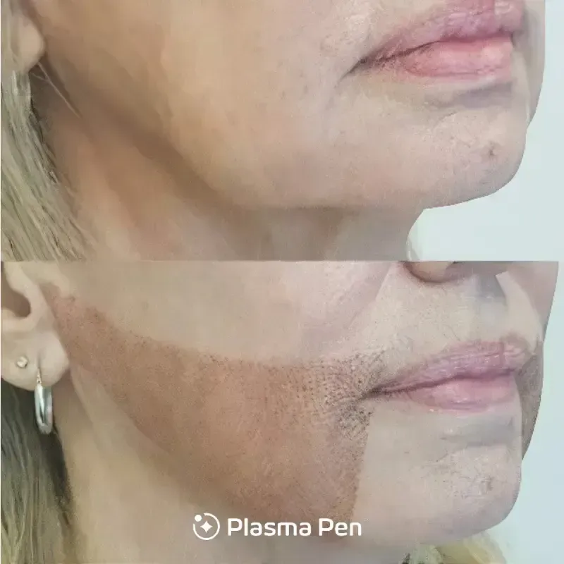 Non-surgical rhinoplasty image background image