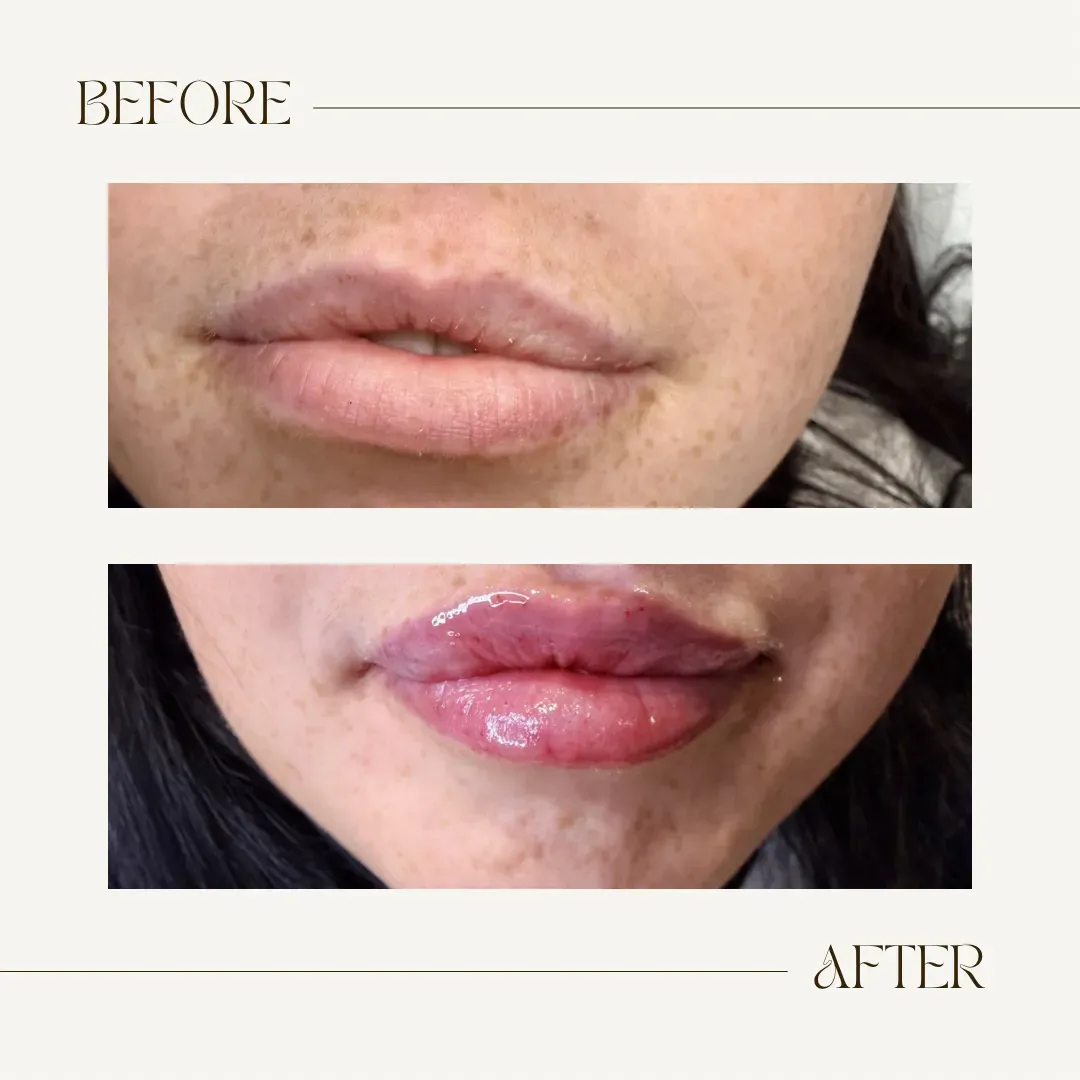 Dermal fillers image background image