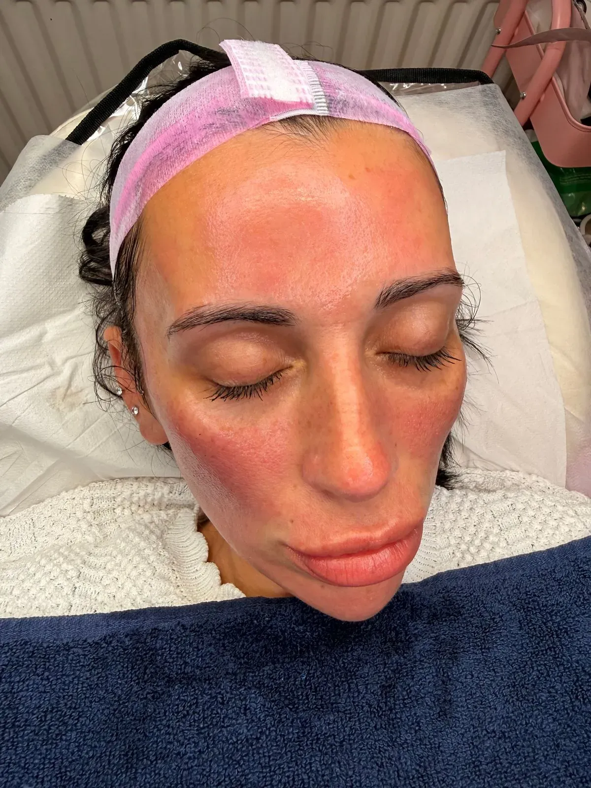 Microneedling