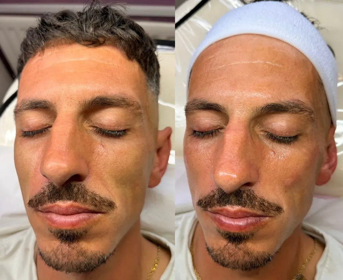 Skin Rejuvenation