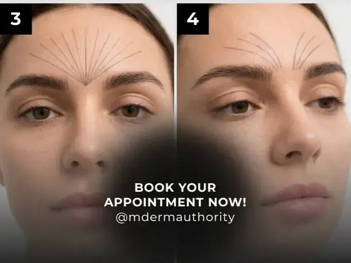 Skin Boosters