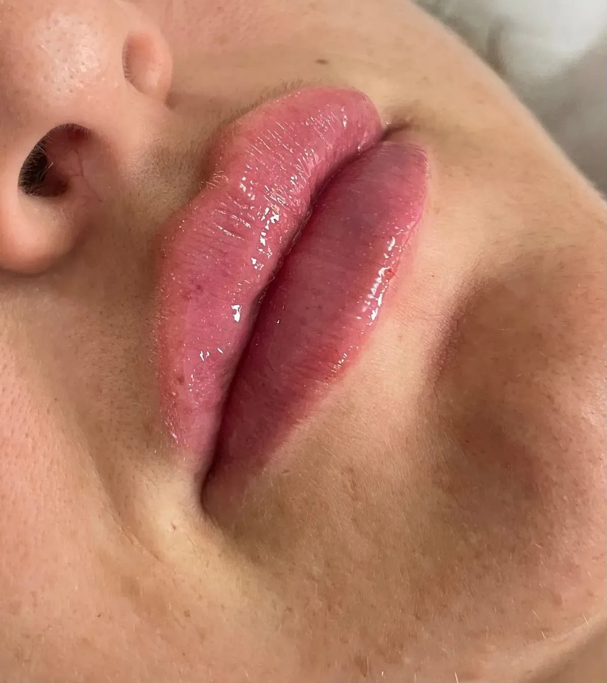 Dermal Fillers