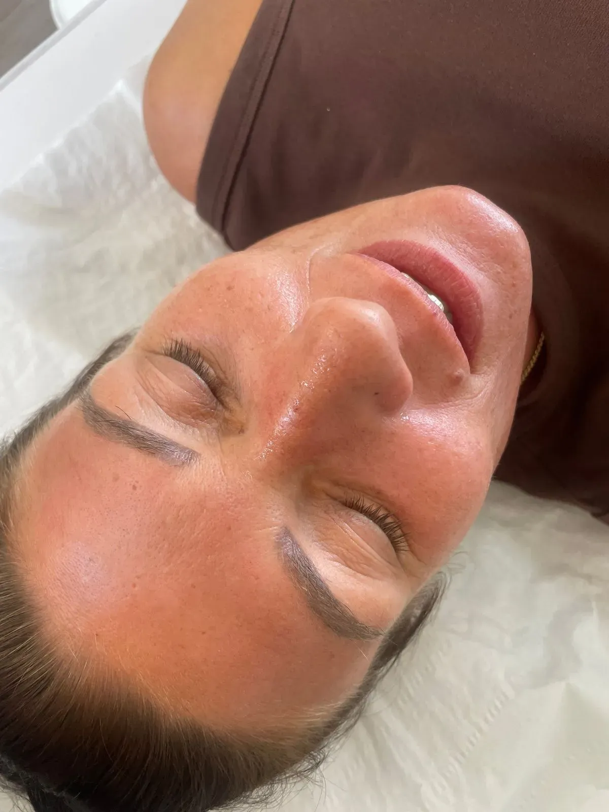 Chemical Peels