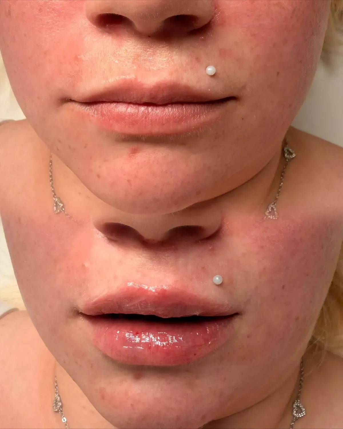 Dermal Fillers