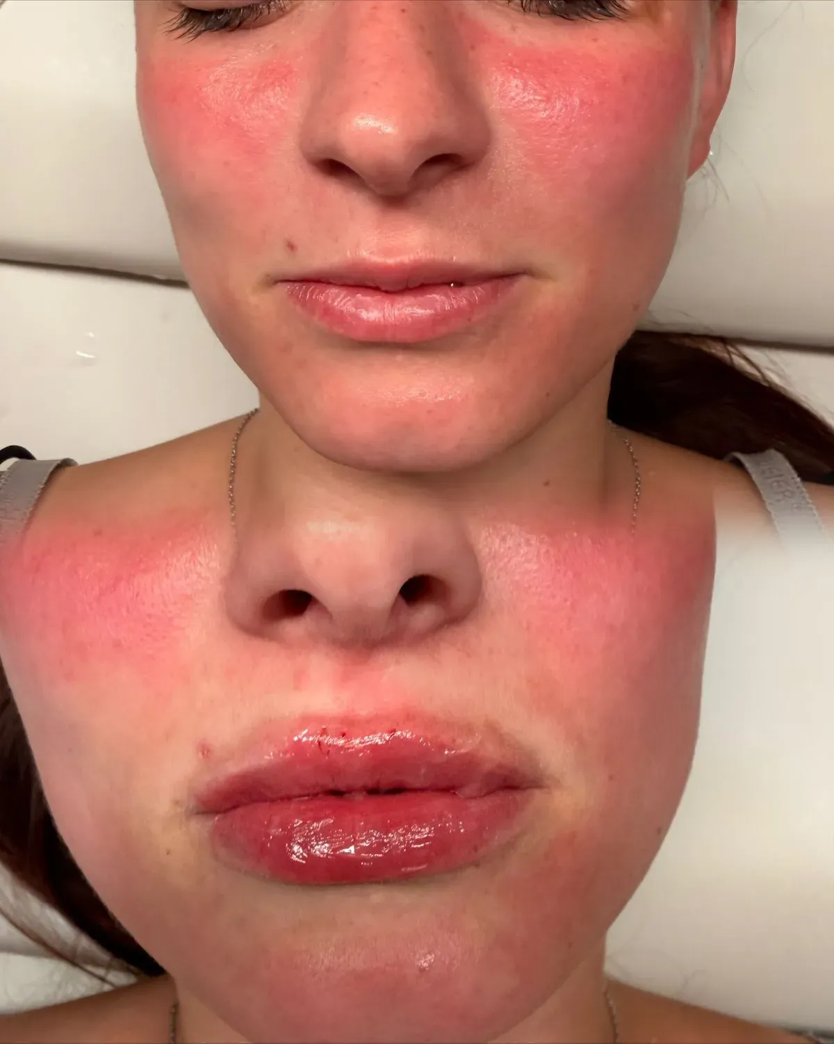 Chemical Peels